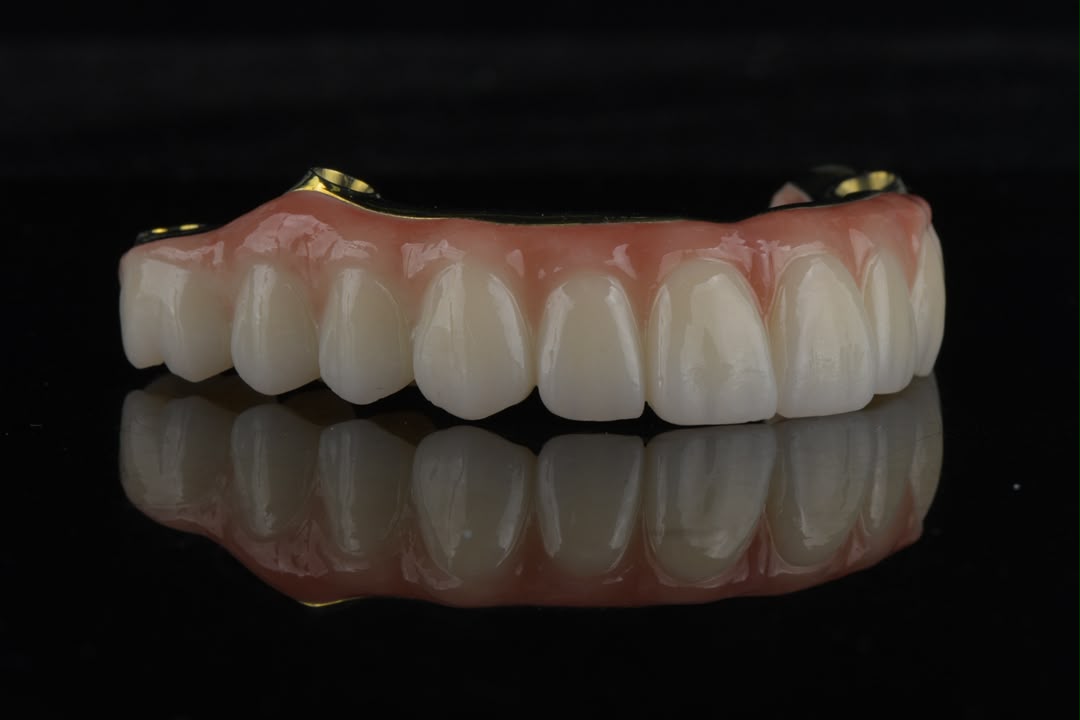 Full-arch zirconia restoration — front view